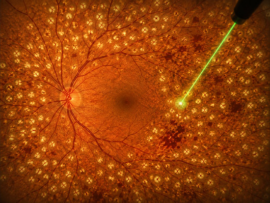 Panretinal lazer fotokoagülasyon: retina fundus görüntüsünde yeşil lazer ışını ve çevredeki lazer izleri