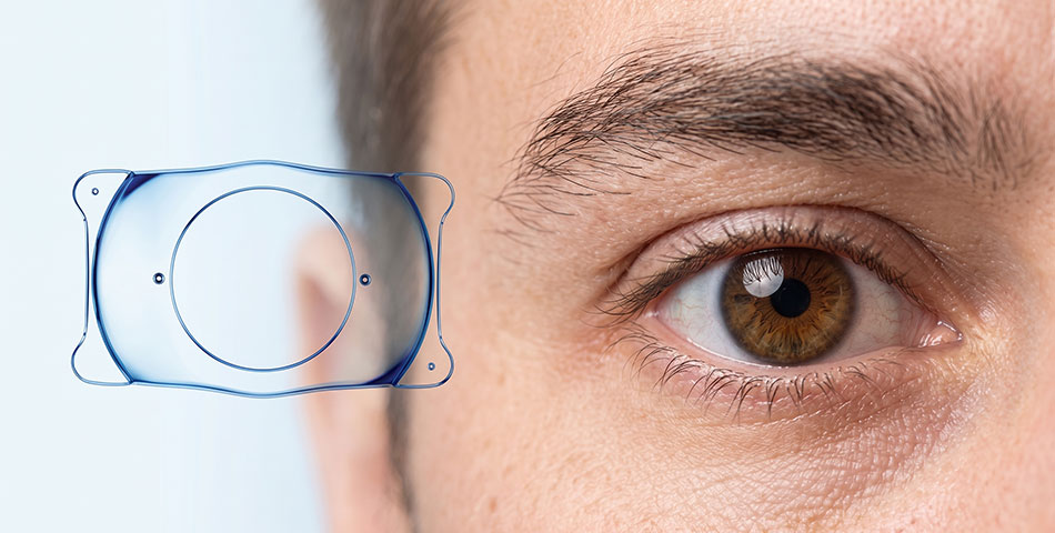 ICL (implante edilebilir kolamer lens) ve göz
